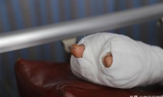 刘忠军3d打印可以手指再造吗我左手缺少食指、中指非常苦恼想问一下通过3D打印技术能再造出来两根手 手指修复再造手术